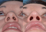 After Nose Surgery