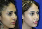 Best Nose Surgery