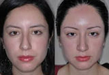 Bulbous Nose Surgery