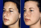 Cheap Nose Surgery