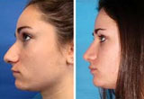 Cosmetic Nose Surgery