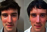 Crooked Nose Surgery