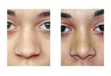 How to Reshape Nose without Surgery