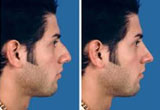 Male Nose Surgery