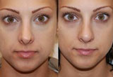 No Surgery Nose Job