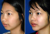 Nose Bridge Surgery