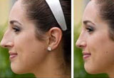 Nose Correction Surgery