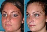 Nose Plastic Surgery
