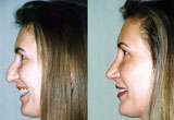 Nose Reshaping Surgery