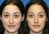 Nose Surgery Before and After