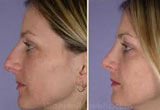 Nose Surgery UK