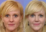Nose Surgery