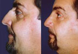 Surgery for Broken Nose