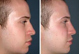 Surgery for Nose