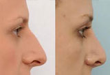 Wide Nose Surgery